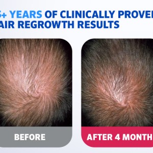 محلول ماینوکسیدیل ۵% rogaine