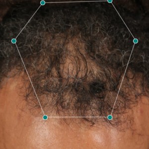 مکمل ضد ریزش و رشد مجدد مو