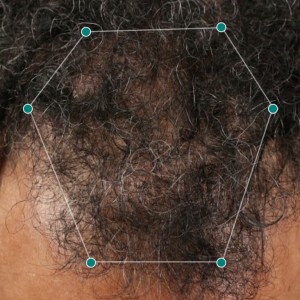 مکمل ضد ریزش و رشد مجدد مو