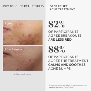 سرم ضد جوش  و آکنه عمیق سریع الاثر 30 میل برند murad