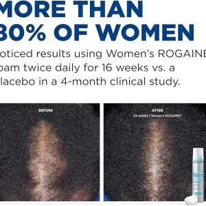 فوم ماینوکسیدیل ۵%ضد ریزش و پرپشت کننده مو مخصوص  بانوان تک قوطی