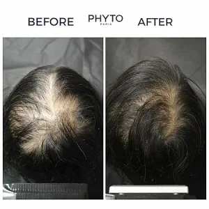 سرم ضد ریزش مو زنانه  87%فیتو Phyto بسته 12 عددی