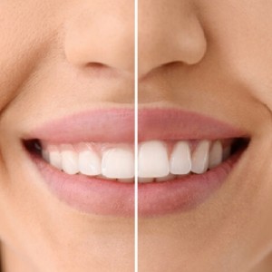 بوتاکس لبخند لثه ای