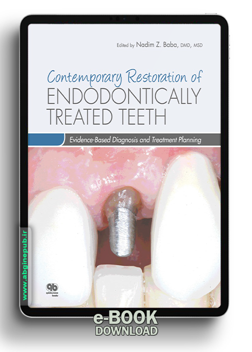 Contemporary Restoration of Endodontically Treated Teeth Evidence-Based Diagnosis and Treatment Planning