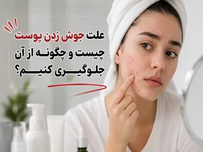 علت جوش زدن پوست چیست و چگونه از آن جلوگیری کنیم؟