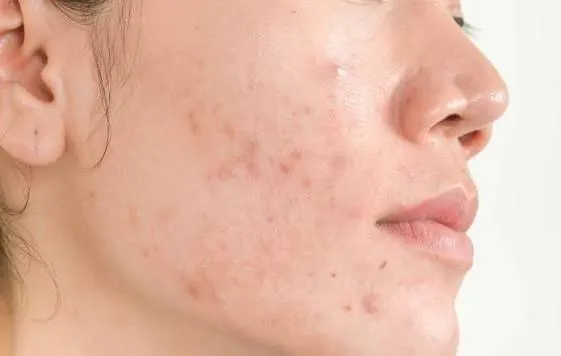 شستشوی پوست پس از ورزش برای پیشگیری از جوش
