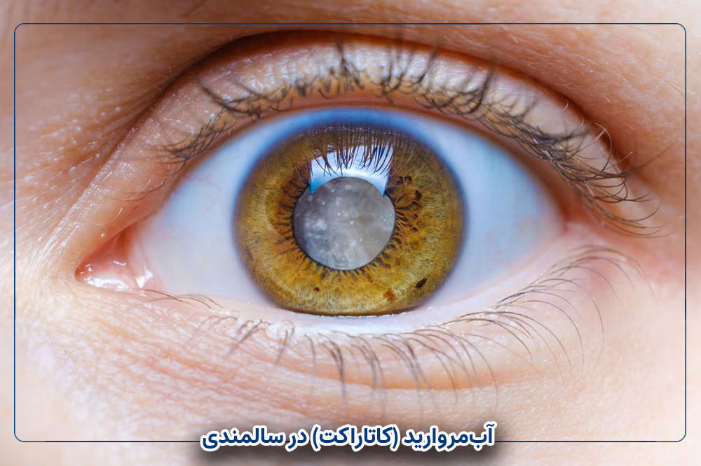 آب‌مروارید (کاتاراکت) در سالمندی