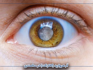 آب‌مروارید (کاتاراکت) در سالمندی