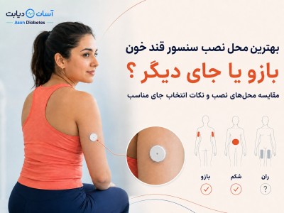 بهترین محل نصب سنسور قند خون | بازو یا جای دیگر؟