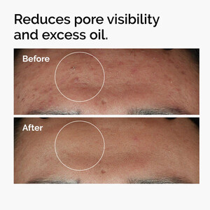 سرم ضدجوش و کنترل‌کننده چربی حاوی نیاسینامید 10% و زینک 1% اوردینری مدل Niacinamide  حجم 30 میل