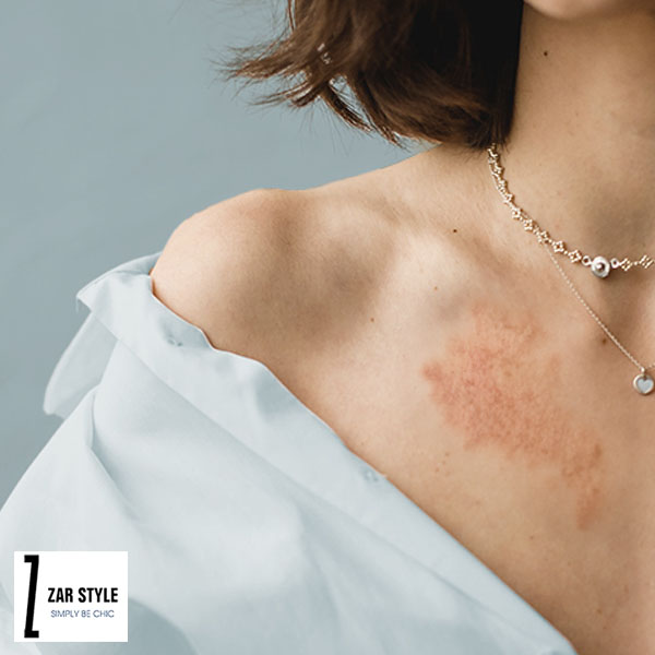 درمان خانگی حساسیت به بدلیجات