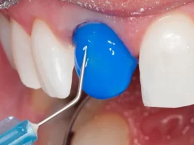 انواع اسید اچ به صورت کامل
