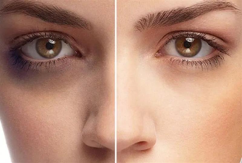 دلایل اصلی پف و تیرگی دورچشم