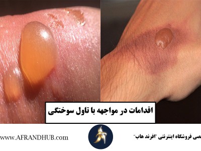 💥 درمان تاول سوختگی | آیا باید تاول را ترکاند یا نه؟