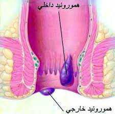 ۱۲ علامت بروز هموروئيد