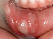 با کمبود این ویتامین ها آفت دهان می زنید