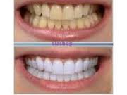 10 علت بدرنگی دندانها و راههای جلوگیری از آنها