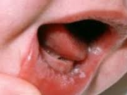 راههاي درمان برفک دهان در کودکان