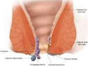 بیماری بواسیر چیست ودرمان آن چگونه است؟
