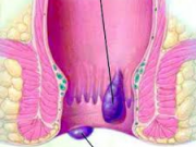 ۱۲ علامت بروز هموروئيد