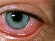 آشنایی با حساسیت‌های چشمی و درمان آن‌ها