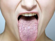 دلایل و درمان خشکی دهان