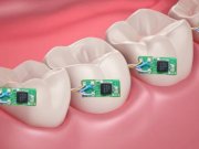 دندانهای ديجيتال