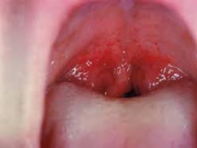 بیماری فارنژیت چیست؟