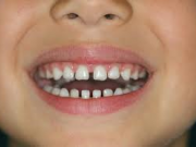 روش درمان دندان های فاصله دار