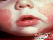 حساسیت غذایی کودکان