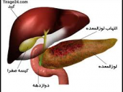 طبیعی ترین راه ها برای مقابله با مشکل کبد چرب