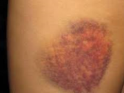 کدام كبودي‌ها نشانگر بيماري‌ خطرناكي است؟