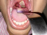 بیماری دیفتری یا خناق چیست؟