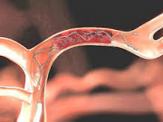 جلوی لخته‌های خونی را بگیریم؟