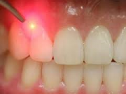 مراقبت از لثه با تغذیه مناسب