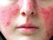 مشخصات و نشانه های بیماری لوپوس