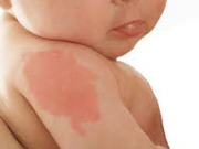 درمان ماه‌ گرفتگی کودک !