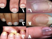 تشخیص بیماری ها از روی تغییرات ناخن