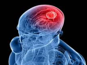 اولین علامت نیمی از تومورهای مغزی را بدانید