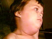 علایم بیماری اوریون چیست؟