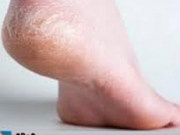 درمان خانگی ترک پا