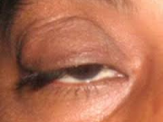 علل افتادگي پلک و راههاي پيشگيري و درمان آن