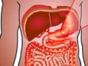 رفلاکس معده به مری