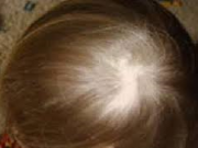 ریزش پوست سر در نوزادان !