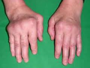 بیماران روماتیسمی از این ۶ اشتباه رایج دوری کنند