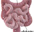 علائم سرطان روده بزرگ و مراحل تشخیص آن