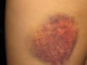 15نشانه سرطان که خانمها نادیده می گیرند