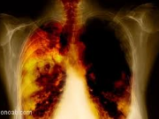 سرطان ریه کشنده ترین سرطان است