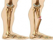 علائم شکستگی استخوان و راههای درمان