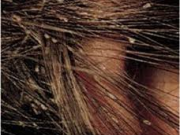 شپش و راهای درمان آن